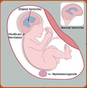 Spinal bifida diagram