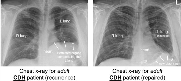 adult cdh xray