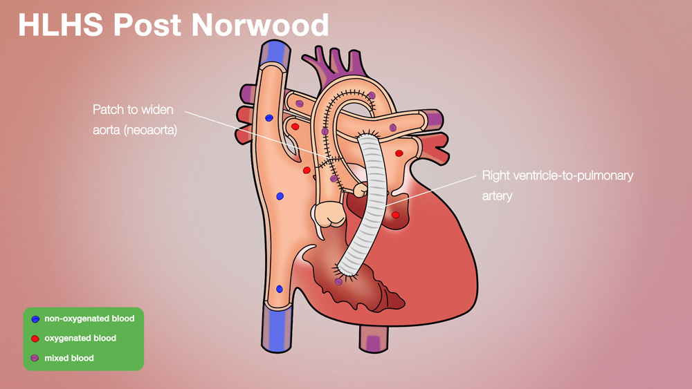 HLHS Post-Norwood Anatomical Heart