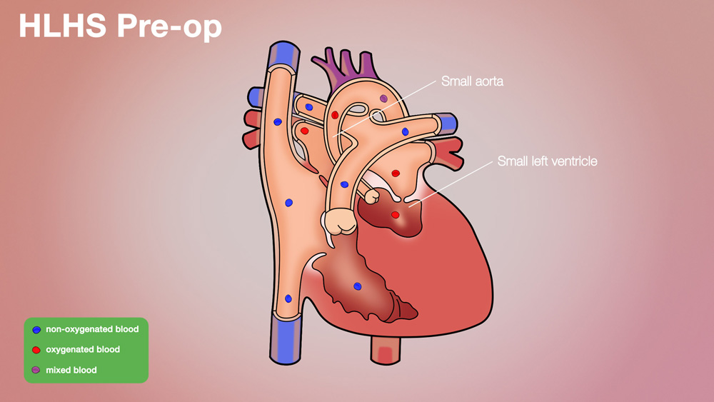 HLHS Pre-op Anatomical Heart