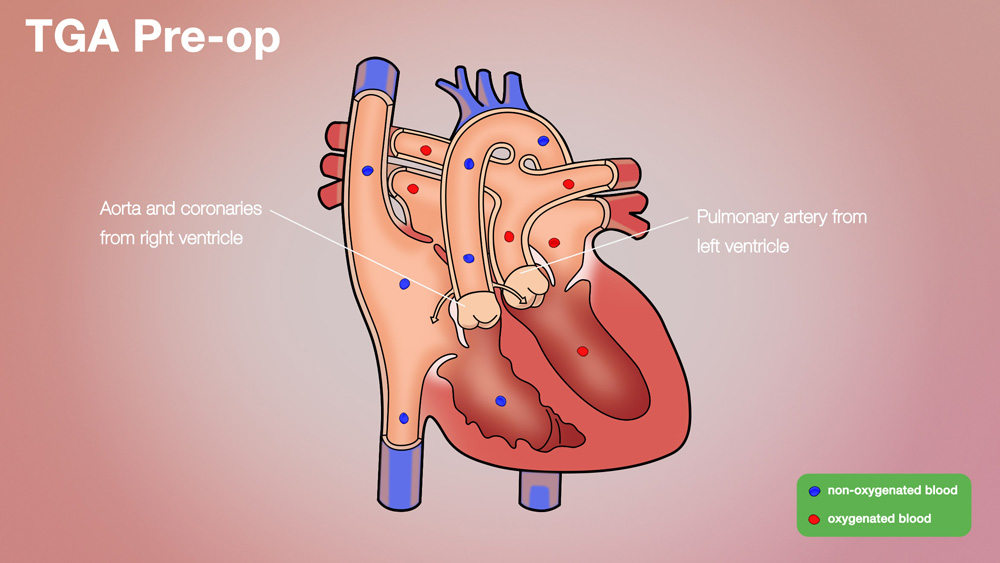 TGA Pre-op Anatomical Heart