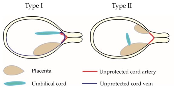 Dr. Papanna’s rough illustrations of Type 1 and Type 2