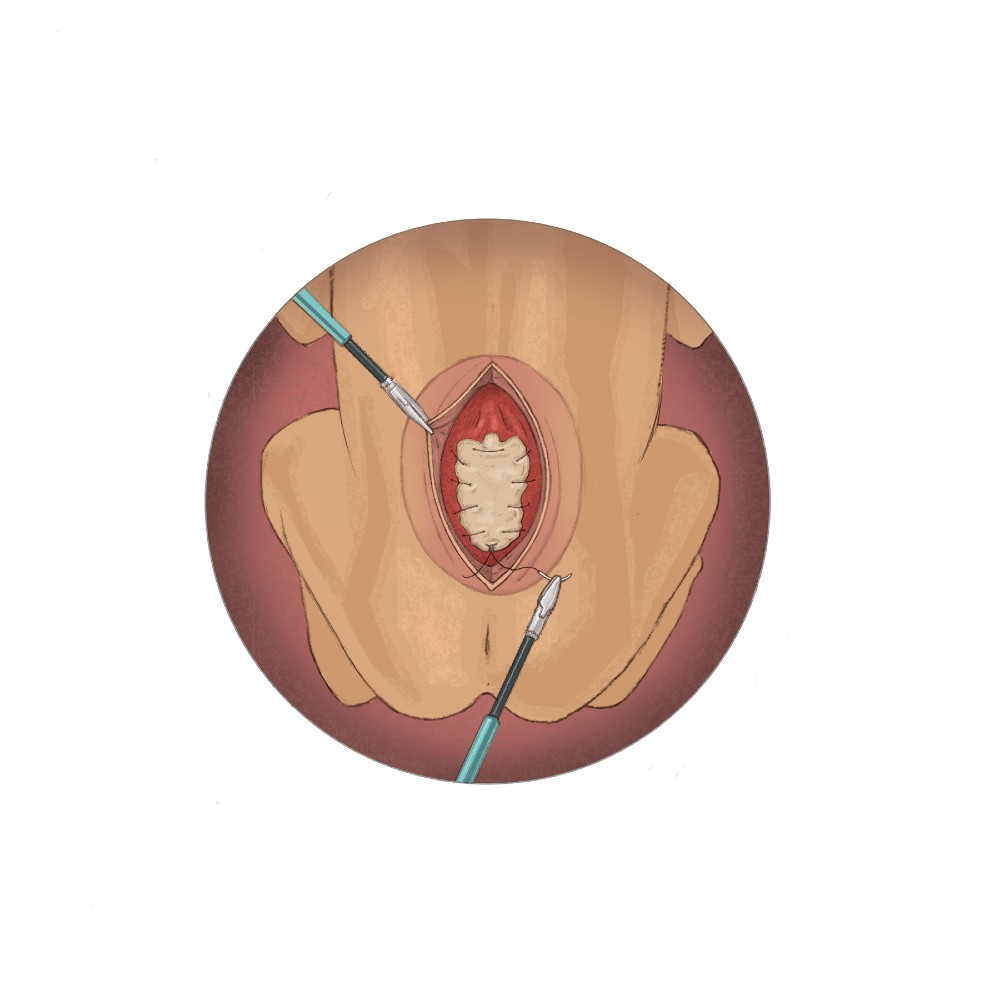 Fetoscopic Spina Bifida Repair Patch