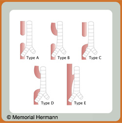 Esophageal Atresia 