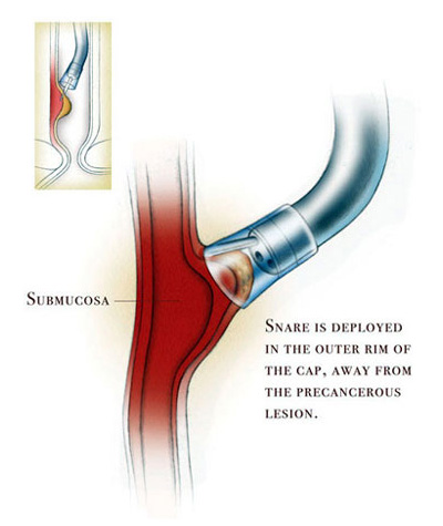 Endoscopic Mucosal Resection Procedure