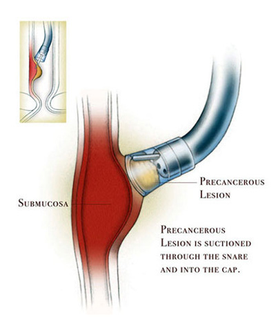 Endoscopic Mucosal Resection Procedure