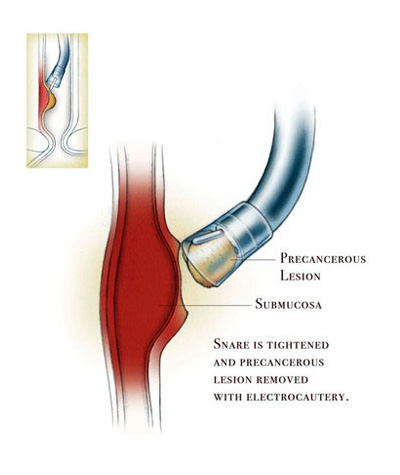 Endoscopic Mucosal Resection Procedure