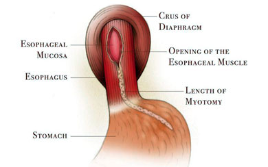 Laparoscopic Heller Myotomy Procedure