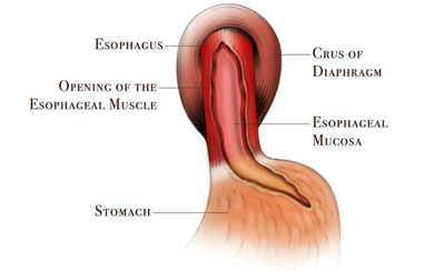 Laparoscopic Heller Myotomy Procedure