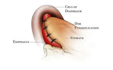 Laparoscopic Heller Myotomy Procedure