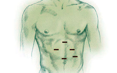 Laparoscopic Nissen Fundoplication Procedure