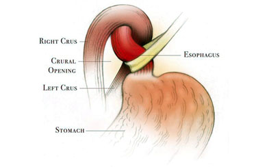 Laparoscopic Nissen Fundoplication Procedure