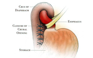 Laparoscopic Nissen Fundoplication Procedure