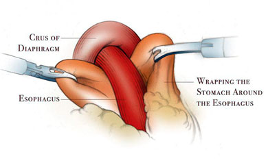 Laparoscopic Nissen Fundoplication Procedure