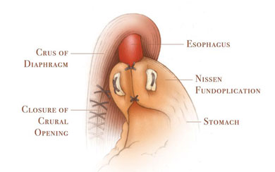 Laparoscopic Nissen Fundoplication Procedure