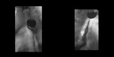 Zenker's Diverticulum